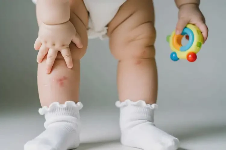 寶寶小腿上起濕疹能治好嗎(圖3)