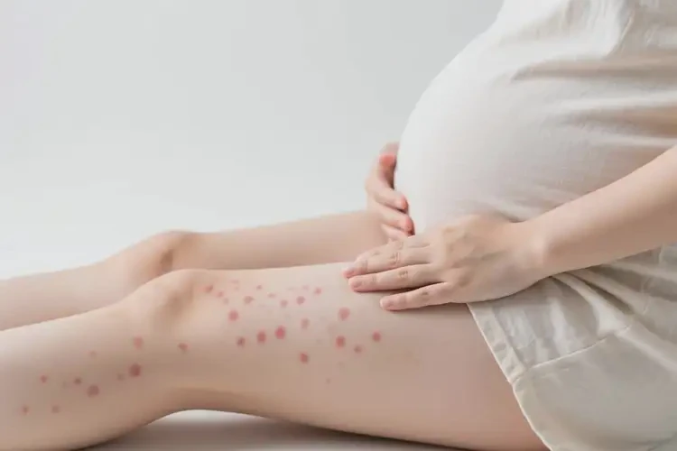 孕妇大腿上偶尔起湿疹可以治好吗(图1)