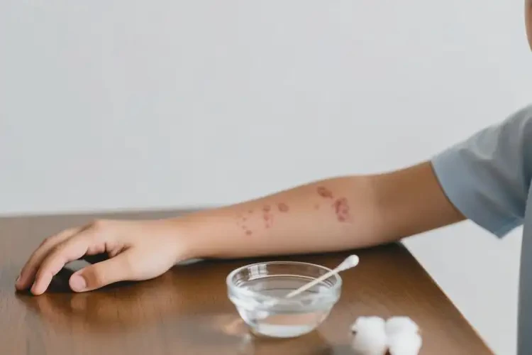 中學(xué)生手臂上偶爾起濕疹可以治好嗎(圖1)