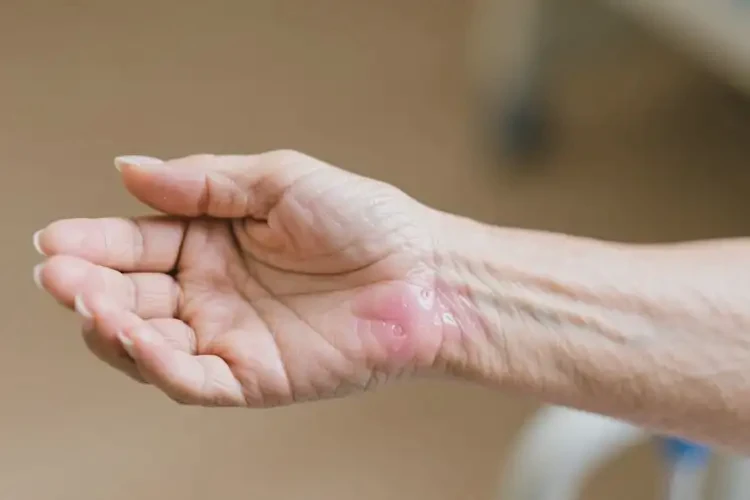 老年人手臂上容易起濕疹可以治好嗎(圖2)