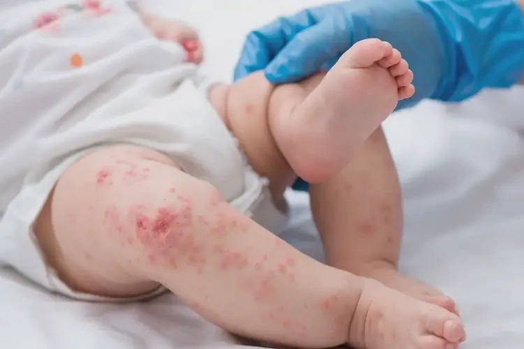 小兒四肢偶爾長(zhǎng)濕疹可以治好嗎(圖4)