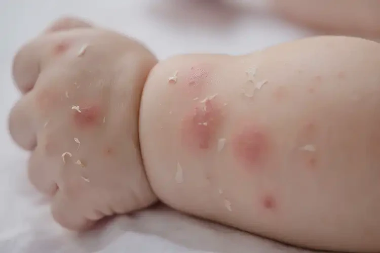 寶寶手臂出濕疹能治好嗎(圖4)