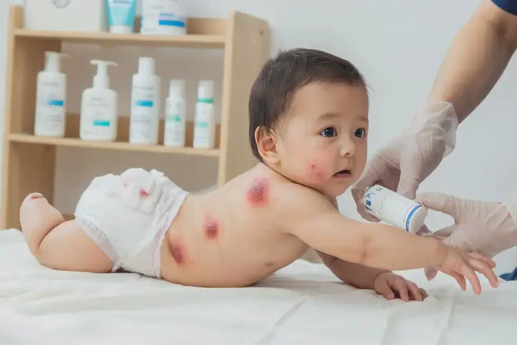 寶寶屁股上偶爾起濕疹不管它會自己好嗎(圖4)