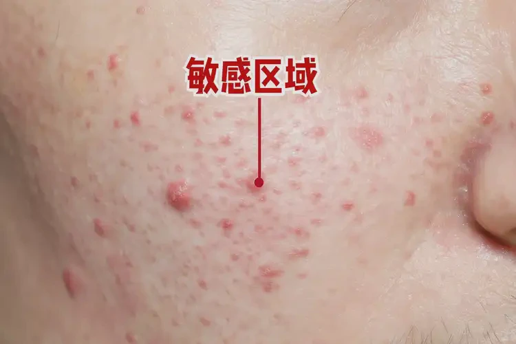 老人肛周长湿疹不管它会自己自愈吗(图4)