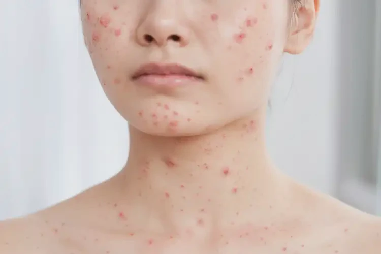 女性脖子上長濕疹可以治好嗎(圖4)