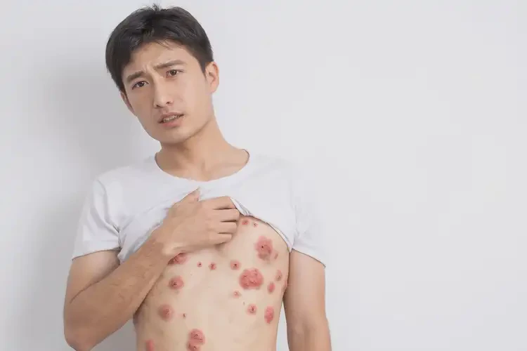 青年人肚子偶爾起濕疹可以治好嗎(圖4)