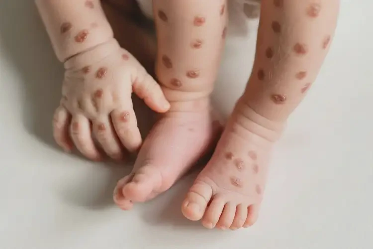 新生儿四肢出湿疹可以治好吗(图1)