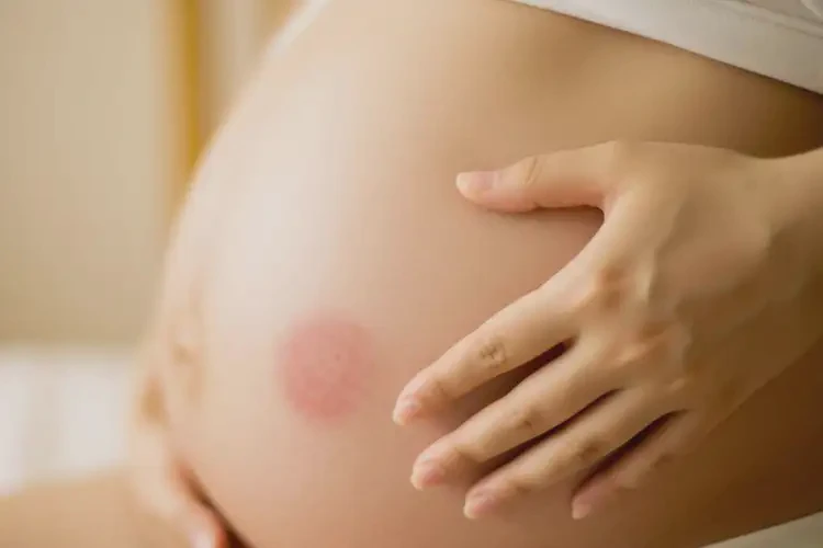 產(chǎn)婦肚子長(zhǎng)濕疹可以治好嗎(圖4)