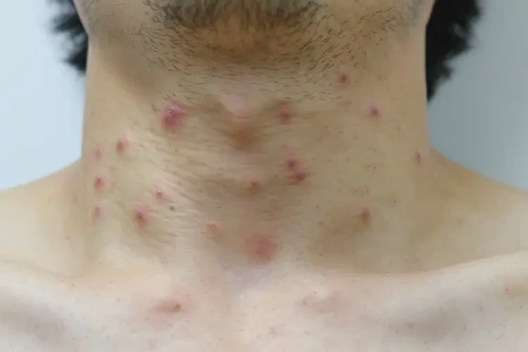 青年人脖子經(jīng)常起濕疹可以徹底自愈嗎(圖4)