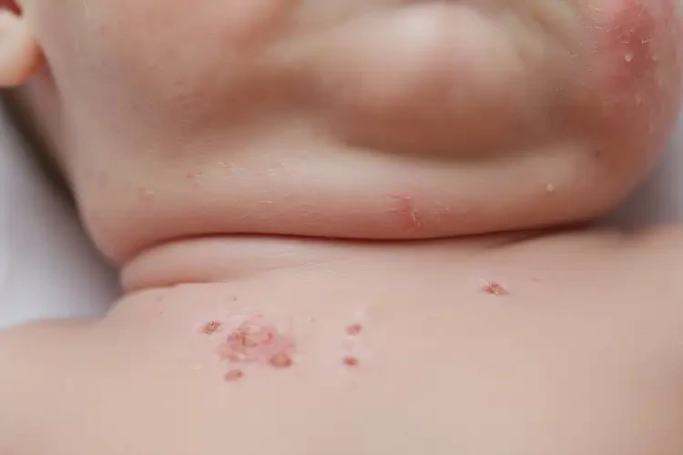 新生兒脖子上容易起濕疹不管它會自己自愈嗎(圖4)