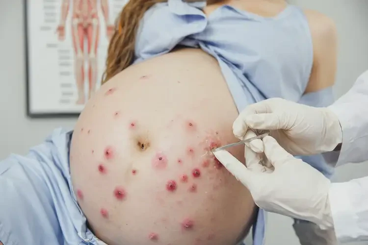 產(chǎn)婦肛周起濕疹可以治好嗎(圖4)