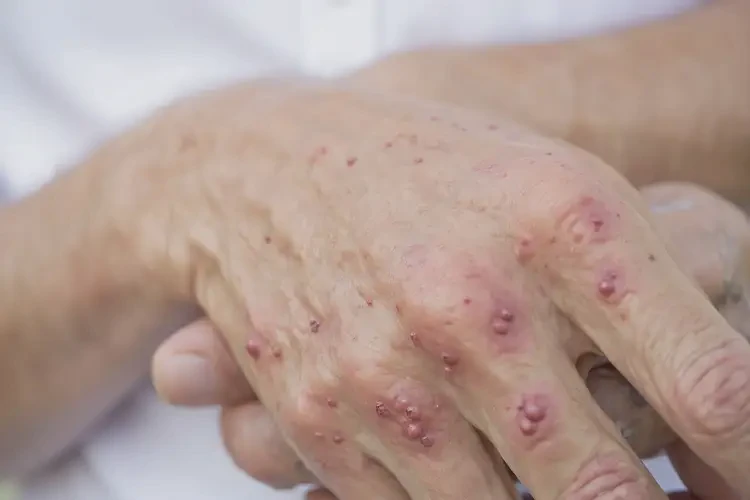 老年人手上經(jīng)常起濕疹可以治好嗎(圖4)