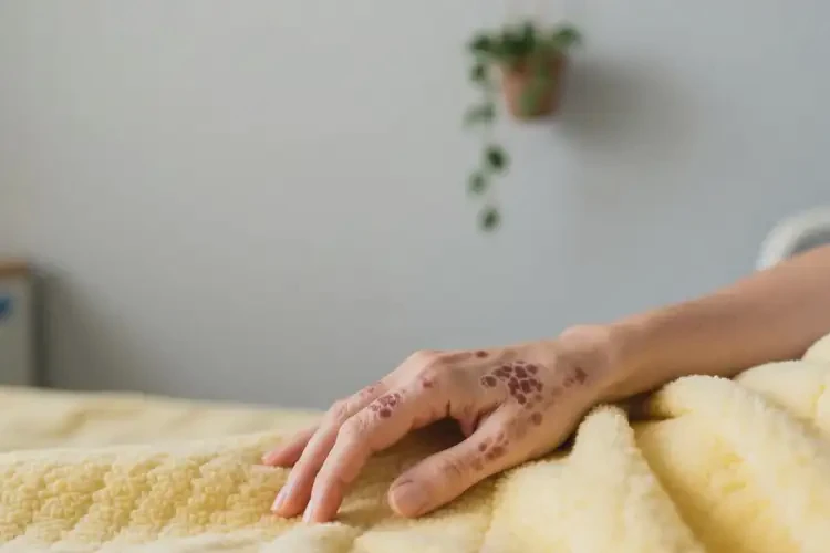 女人身上出現(xiàn)濕疹可以治好嗎(圖1)