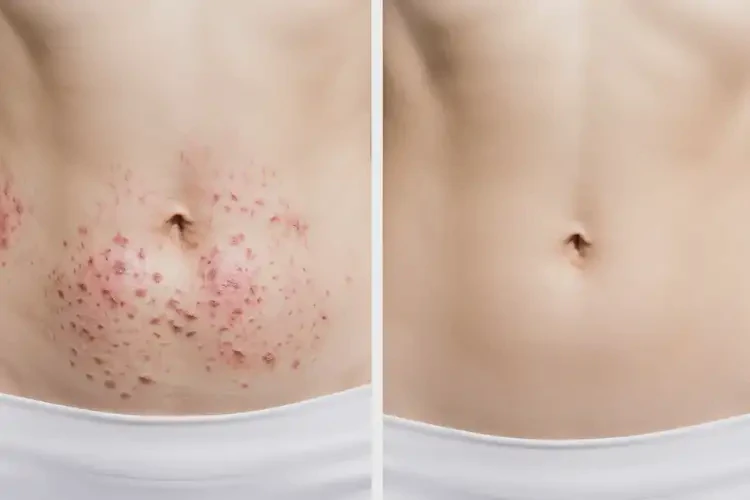 女人肚子有濕疹可不可以根治(圖1)