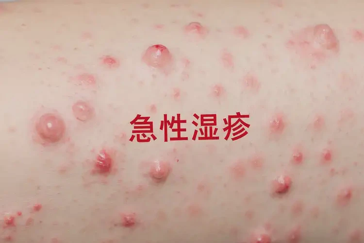 男生身上出现湿疹可以治好吗(图4)