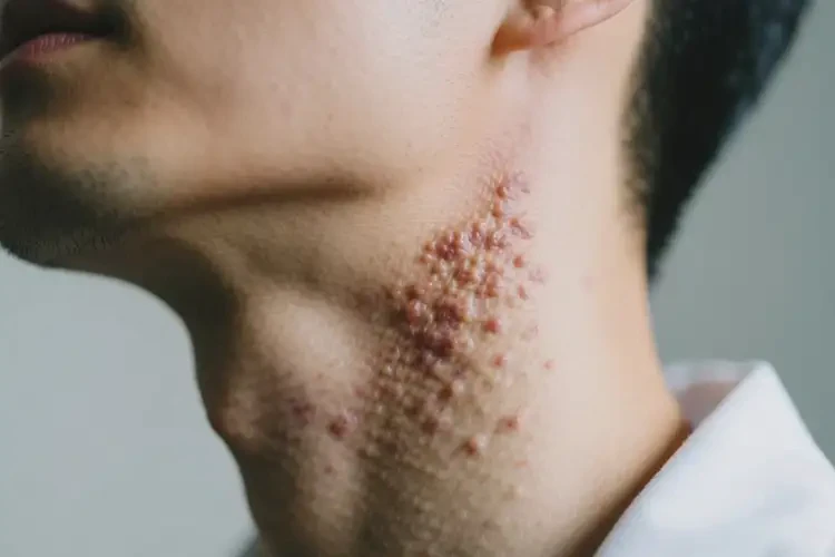 男人脖子長濕疹可不可以根治(圖3)