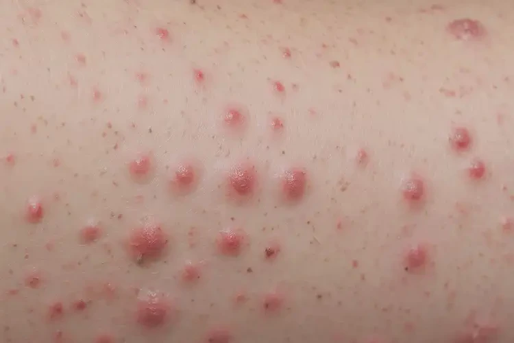 幼兒手臂上出濕疹可以治好嗎(圖4)