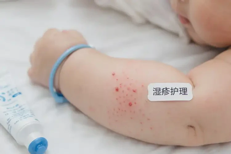 嬰兒手臂容易長濕疹能治好嗎(圖4)