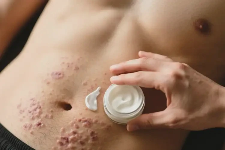 男性肚子容易起濕疹可以治好嗎(圖3)