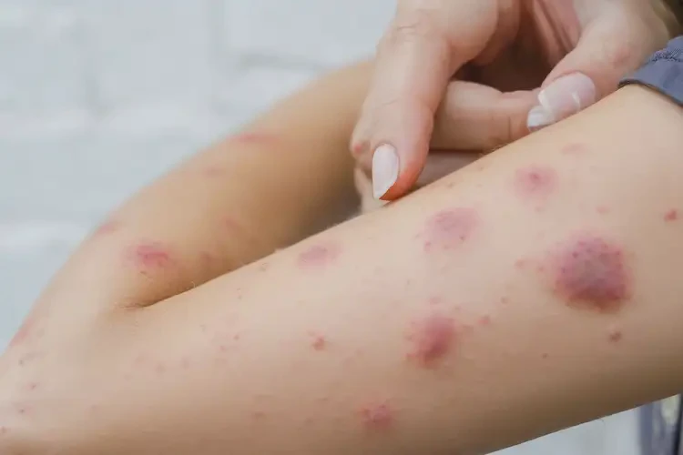 女性四肢偶爾起濕疹可以治好嗎(圖4)