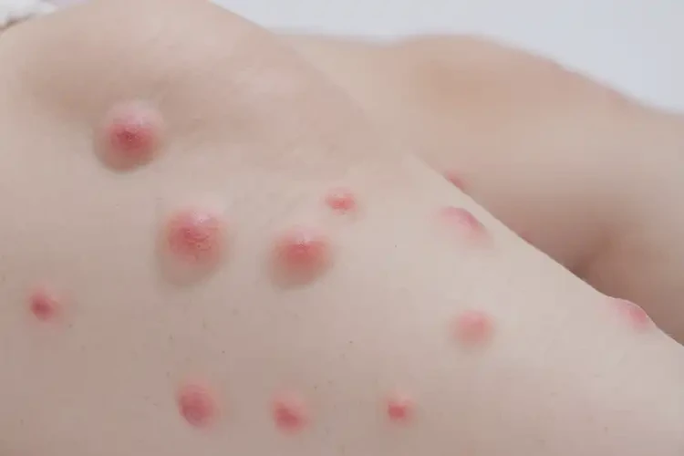 幼儿小腿上偶尔起湿疹可以彻底自愈吗(图4)