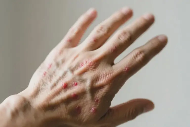 男人手上偶爾長濕疹可不可以根治(圖4)