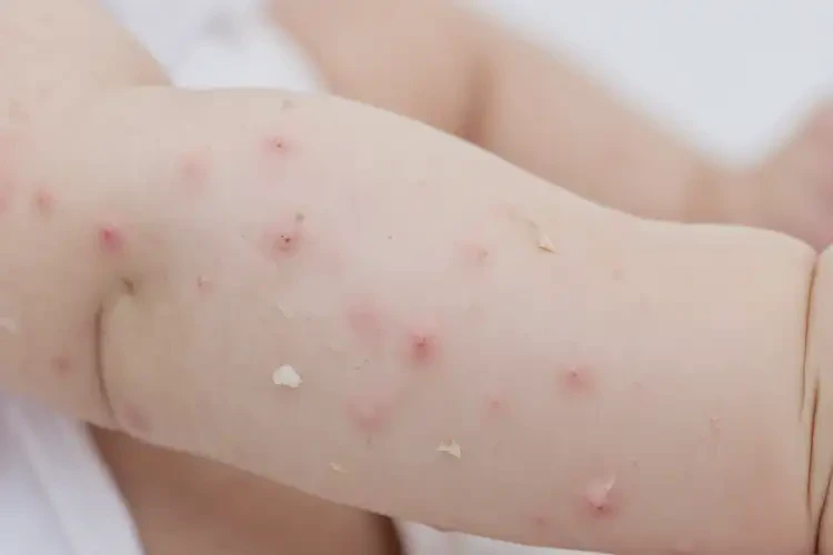 幼儿四肢容易起湿疹可以治好吗(图4)
