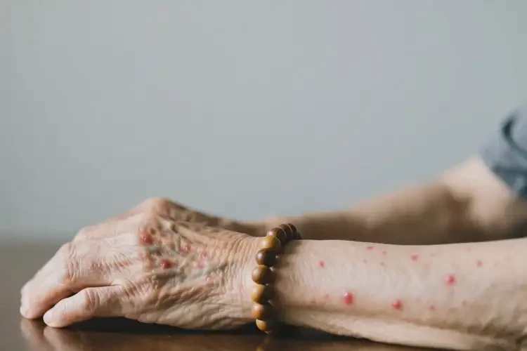 老年人手臂上容易起濕疹可以治好嗎(圖3)