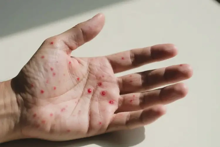 男人手上偶爾長濕疹可不可以根治(圖3)