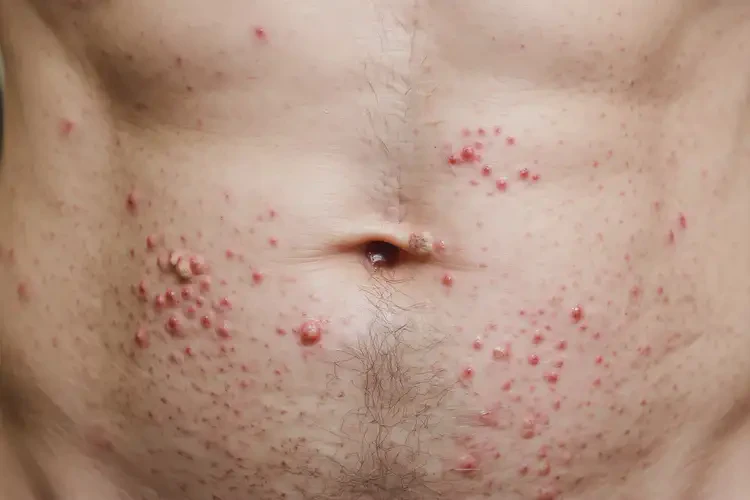 男性肚子經(jīng)常長濕疹可以治好嗎(圖4)