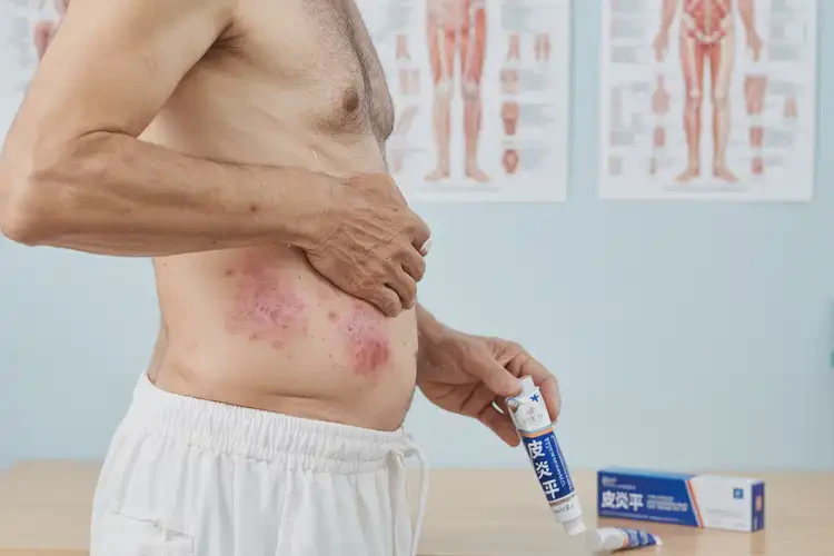 男性屁股有濕疹可以治好嗎(圖4)