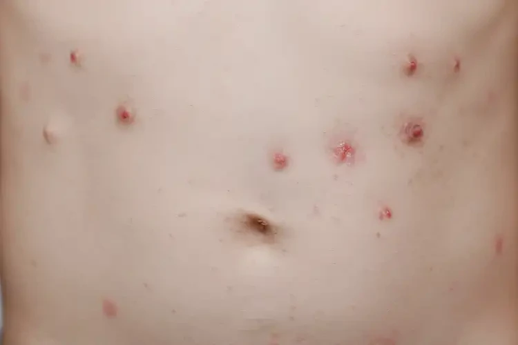 小學生肚子上經(jīng)常長濕疹能夠徹底治愈嗎(圖4)