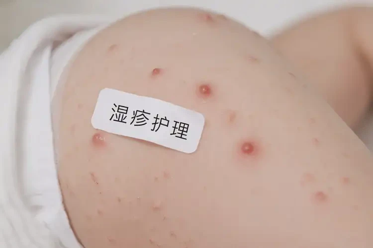 小兒屁股上有濕疹可以治好嗎(圖4)