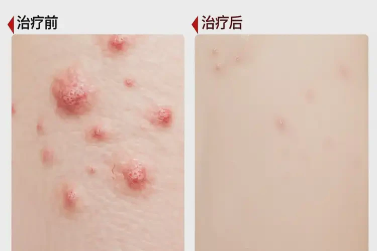 男生身上有濕疹可以治好嗎(圖4)