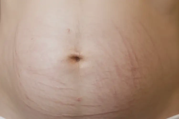 產(chǎn)婦屁股容易起濕疹可以治好嗎(圖4)