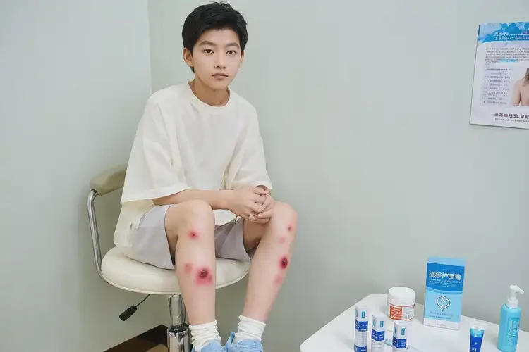 中學生腳上經(jīng)常起濕疹能靠自己自愈嗎(圖2)