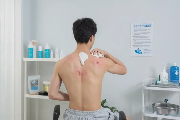 青年人屁股出濕疹可以治好嗎(圖2)