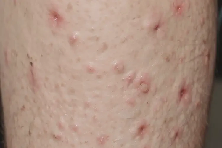 男生小腿經(jīng)常長(zhǎng)濕疹可以治好嗎(圖4)