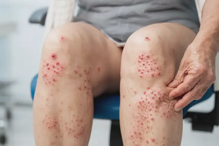 女人大腿上出湿疹可以彻底自愈吗(图4)