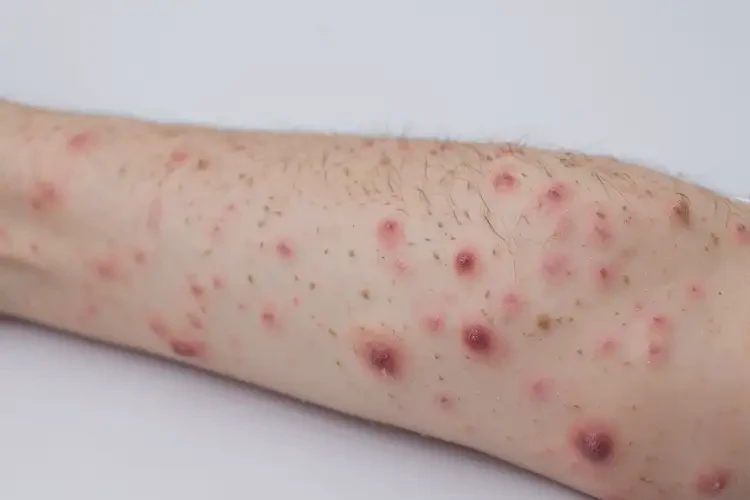 大学生手臂经常起湿疹能彻底自愈吗(图4)