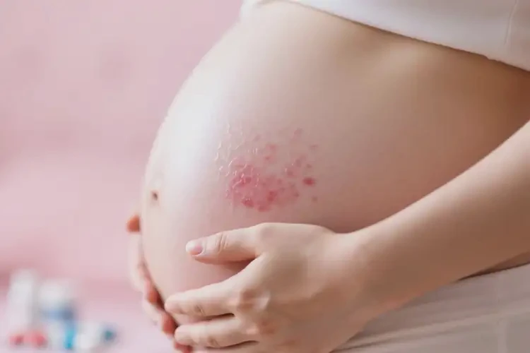 產(chǎn)婦肚子經(jīng)常起濕疹可以治好嗎(圖3)