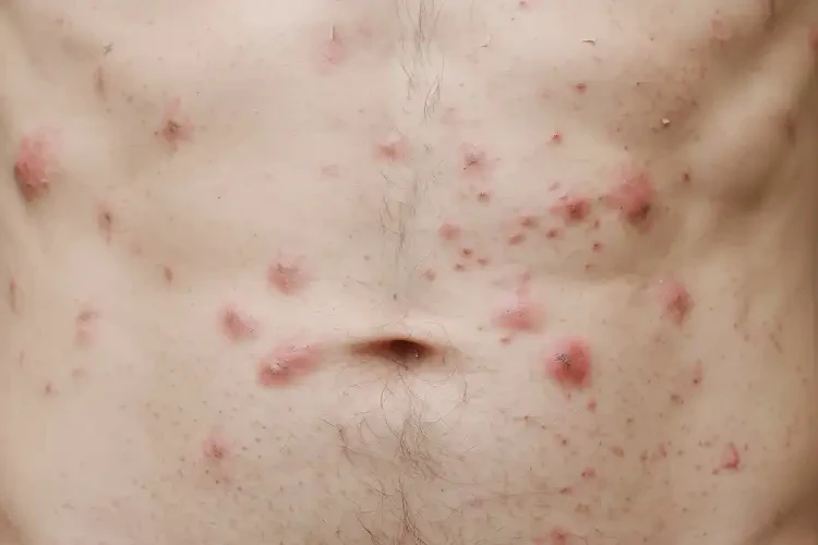 男生肚子出濕疹不管它會(huì)自己好嗎(圖4)