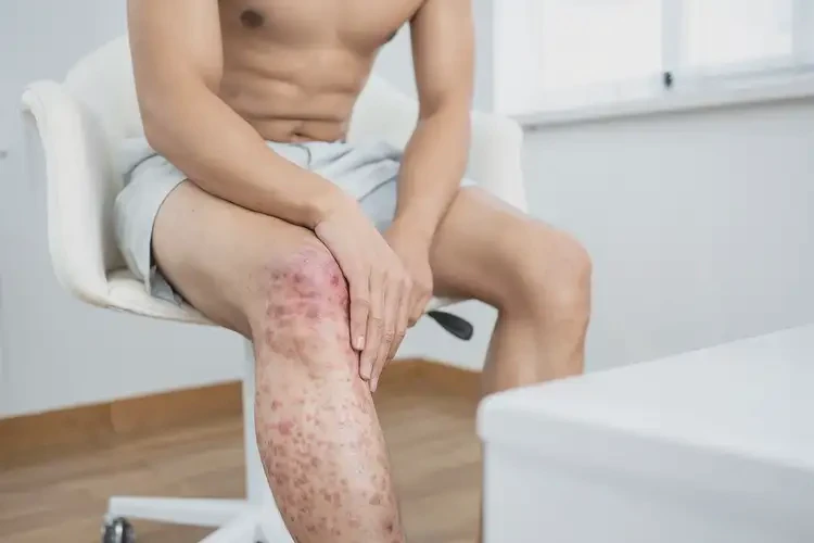 青年人大腿上出現(xiàn)濕疹可以治好嗎(圖3)