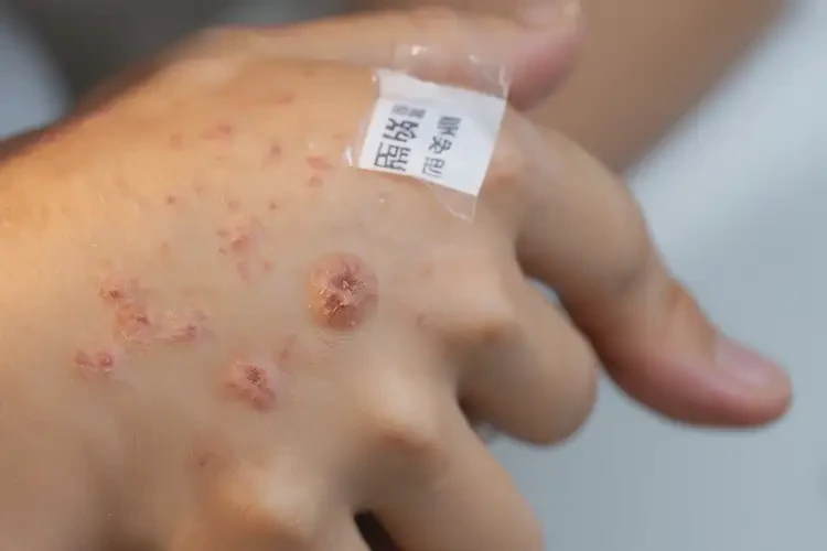 青少年手上容易長(zhǎng)濕疹能不能徹底自愈(圖3)