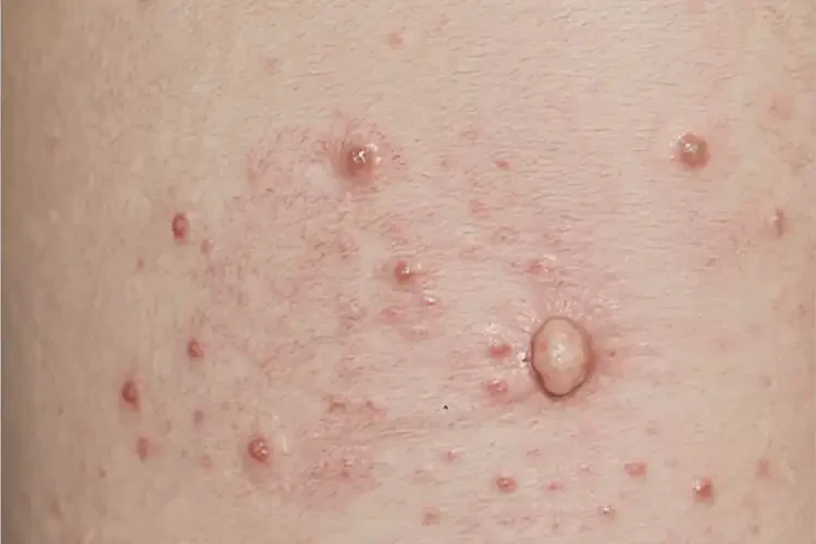 男人肛周起濕疹可以治好嗎(圖3)