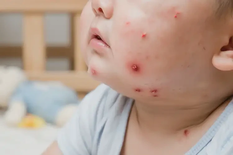 嬰幼兒脖子上出濕疹可以治好嗎(圖4)