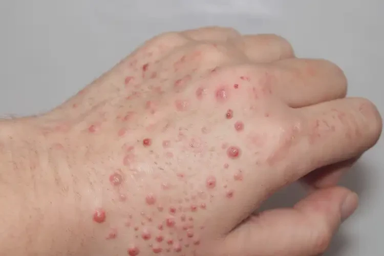 中學生手上容易長濕疹能靠自己自愈嗎(圖4)