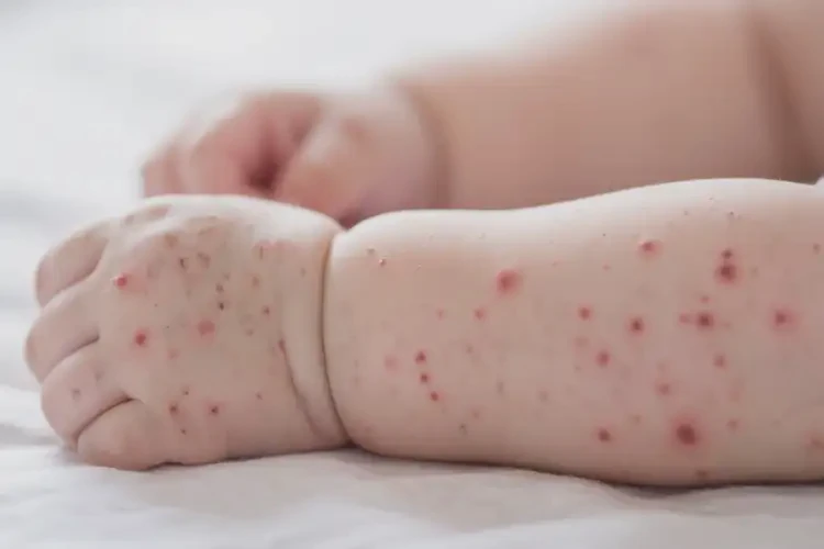 嬰兒手臂上長(zhǎng)濕疹能治好嗎(圖4)