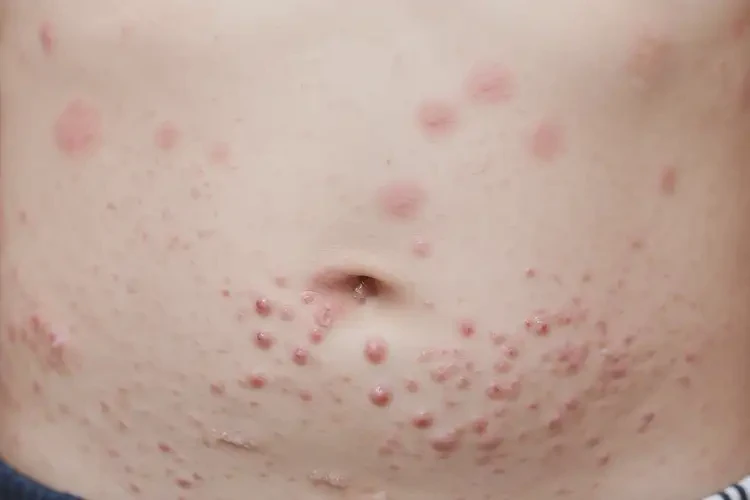 小學生肚子上容易起濕疹可以治好嗎(圖4)