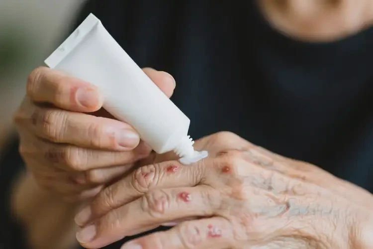 老年人四肢容易起濕疹可以治好嗎(圖3)